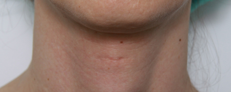 Trach shave scar